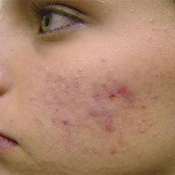 how to removing acne scars naturally fast treatment